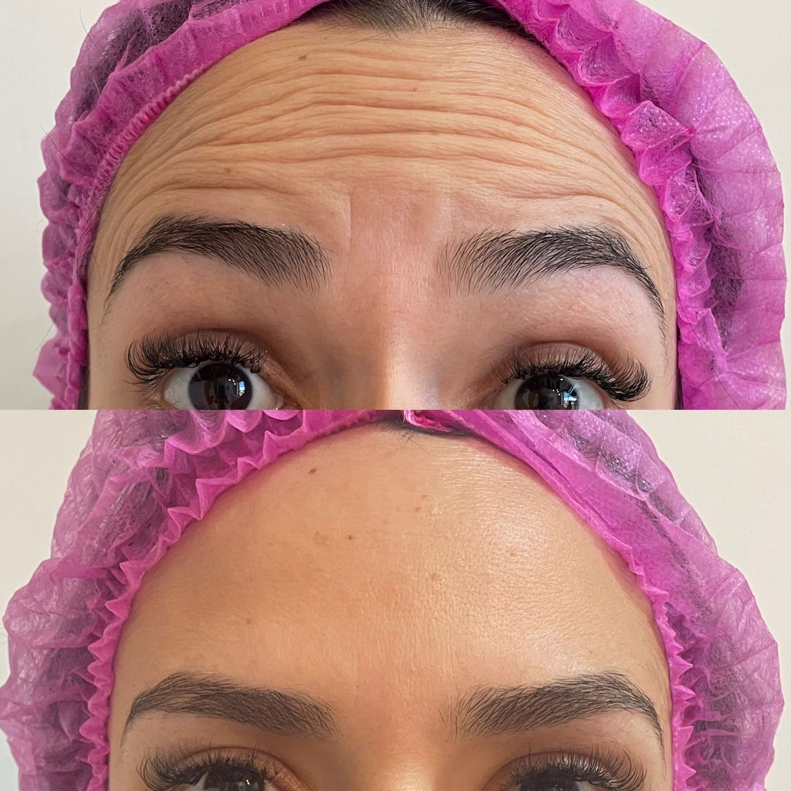 Antes e depois real de toxina botulínica na região frontal